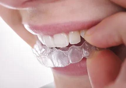 Invisable braces